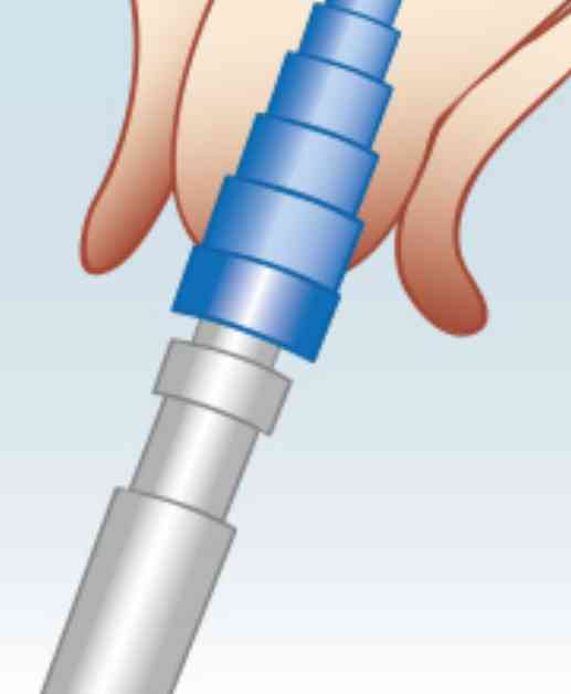Mit einem Setzinstrument wird das Implantat gleich eingesetzt.