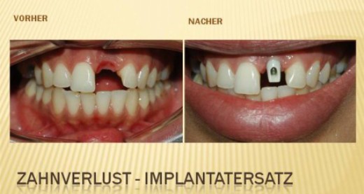 Behandlungsbeispiel für Sofortimplantation: 1 - Zahnarztpraxis Wien