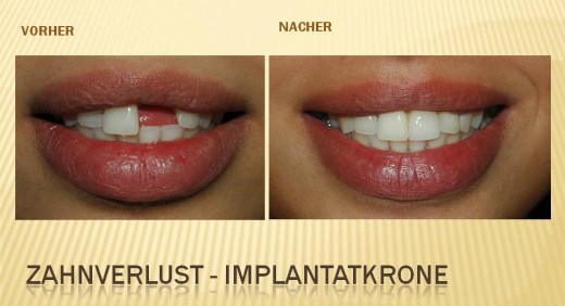 Behandlungsbeispiel für Sofortimplantation: 2 - Zahnarztpraxis Wien