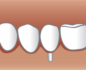 Schematische Darstellung Implantation: Schritt 3 - Zahnarztpraxis Wien