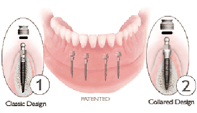 Miniimplantate Pro - Zahnarztpraxis Wien