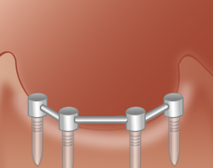Schematische Darstellung Implantatprothese: Schritt 1 - Zahnarztpraxis Wien