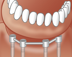 Schematische Darstellung Implantatprothese: Schritt 2 - Zahnarztpraxis Wien