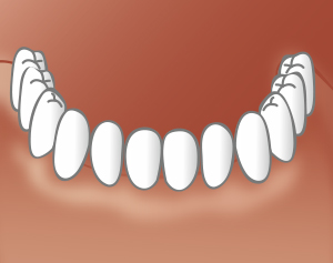 Schematische Darstellung Implantatprothese: Schritt 3 - Zahnarztpraxis Wien