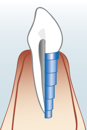 Zahnimplantat - Zahnarztpraxis Wien