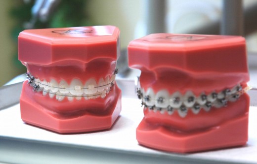 Unterschiedliche Zahnspangen - Zahnarztpraxis Wien