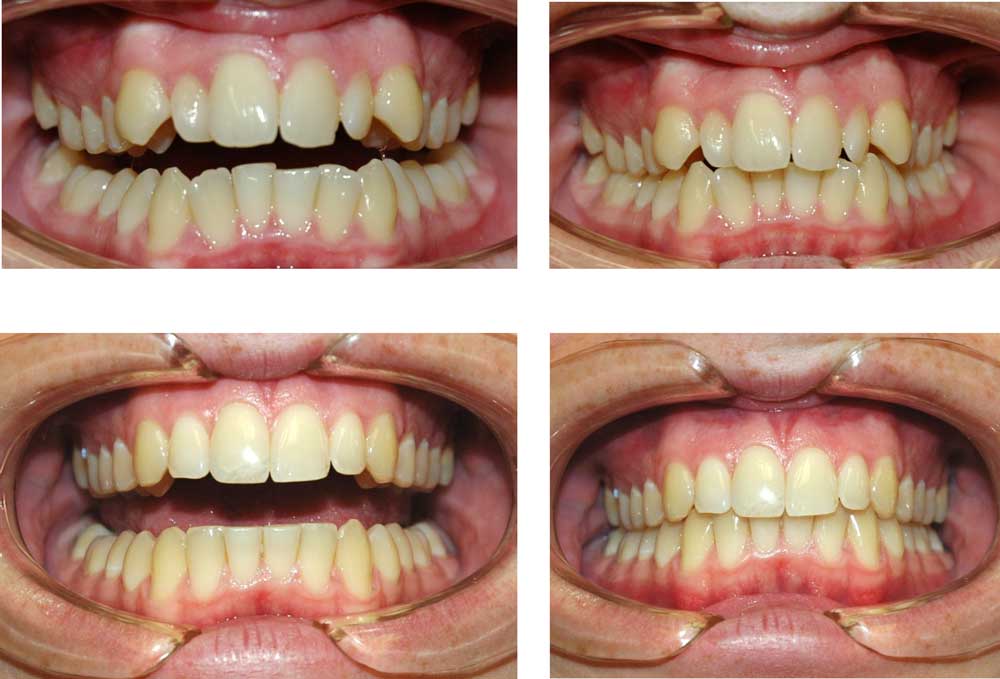 Behandlungsbeispiel für fixe Regulierung - Zahnarztpraxis Wien
