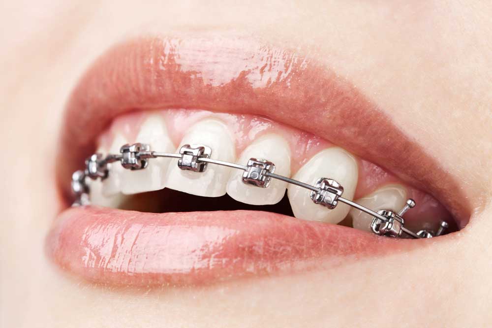 Zahnspange - Zahnarztpraxis Wien