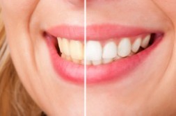 Vergleich Vorher - Nachher Bleaching - Zahnarztpraxis Wien