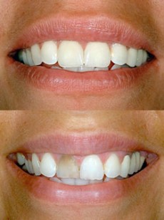 Zahnaufhellung Vorher-Nachher - Zahnarztpraxis Wien