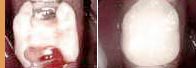 Vergleich Kunststoff-Füllung - Zahnarztpraxis Wien