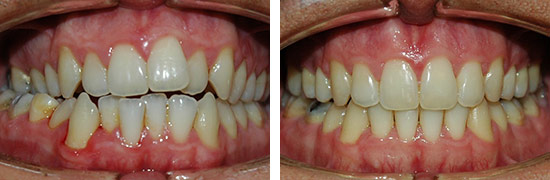 Zahnspange Vorher-Nachher - Zahnarztpraxis Wien