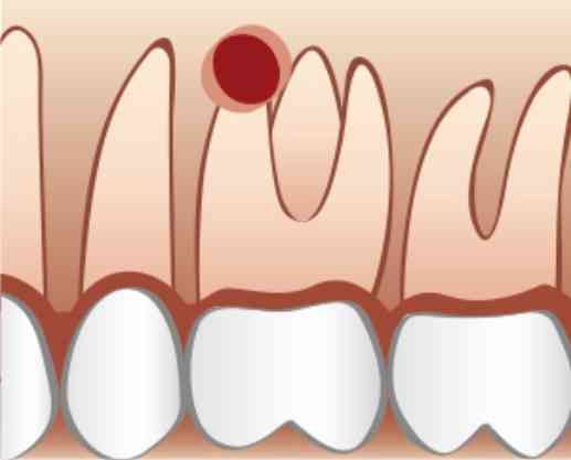 Wurzelspitze und umgebender Knochen des wurzelbehandelten Zahnes sind entzündet - oft bis an die Kieferhöhle heran.